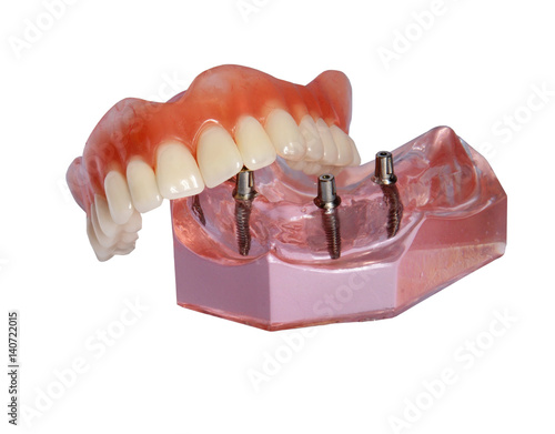 Model of a jaw and denture 2