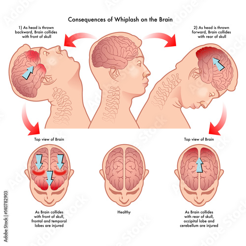 consequences of whiplash on the brain