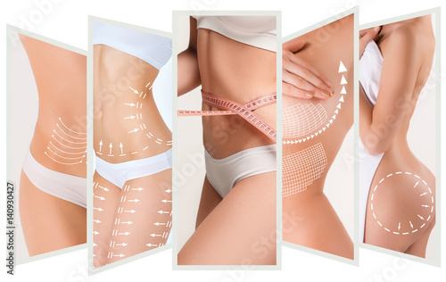 The cellulite removal plan. White markings on young woman body