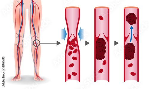 Economy class syndrome mechanism, deep vein thrombosis(DVT), Pulmonary Embolism(PE), coronary thrombosis, illustration diagram