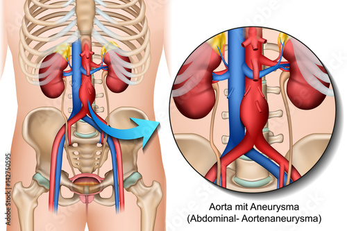 Anatomie Bauchaortenaneurysma, Abdominales Aortenaneurysma illustration