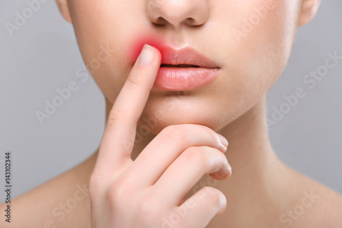 Woman with cold sore touching lips on light background