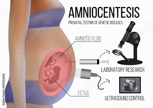 Amniocentesis. Ultrasound control