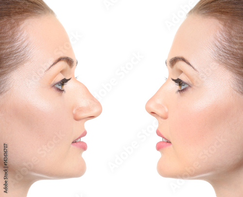 Young woman before and after rhinoplasty on white background. Plastic surgery concept