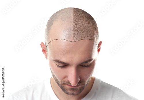 Hair loss concept. Head of man on white background, closeup