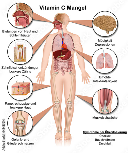 Vitamin C Mangel Anzeichen und Symptome, vektor illustration, Ascorbinsäure