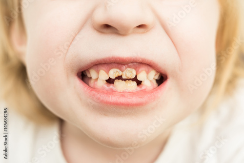 Child blonde showing bad teeth