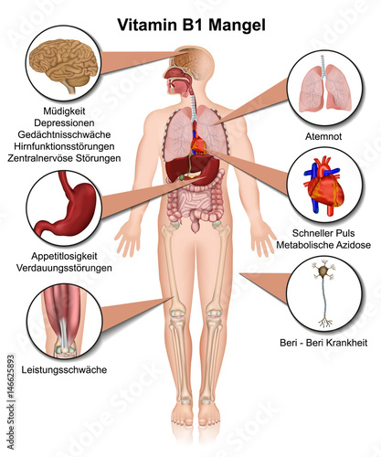 Vitamin B1 Mangel Anzeichen und Symptome, vektor illustration, Thiamin