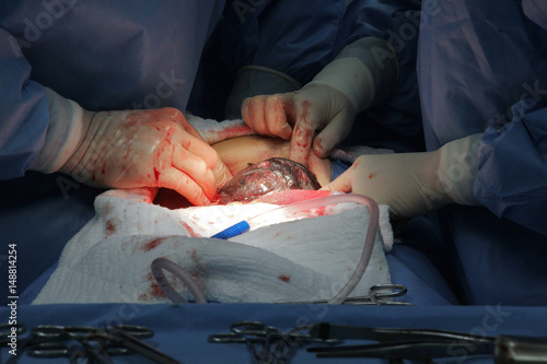 New baby being born during classic cesarean section in the operating theater.