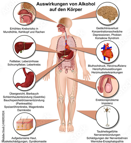Auswirkungen von Alkohol auf den Körper, Alkoholmissbrauch Infografik