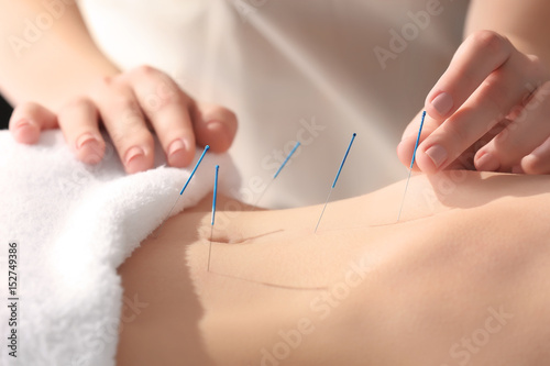 Young woman undergoing acupuncture treatment, closeup