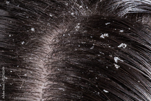 Dandruff on her dark hair