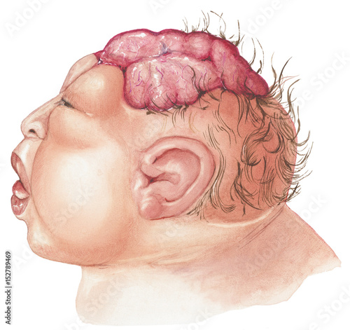 Anencephaly is the absence of a large part of the brain and the skull. Anencephaly occurs early in the development of an unborn baby. It results when the upper part of the neural tube fails to close.