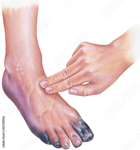 Diabetic arterial disease, showing gangrene and ulcerations of the toes.