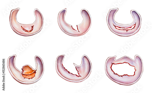 Meniscus tears in the human knee.