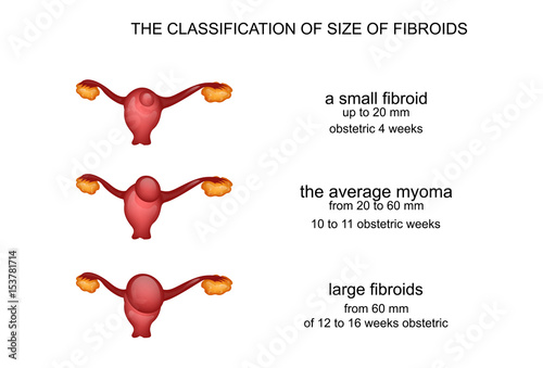 hysteromyoma, uterine myoma