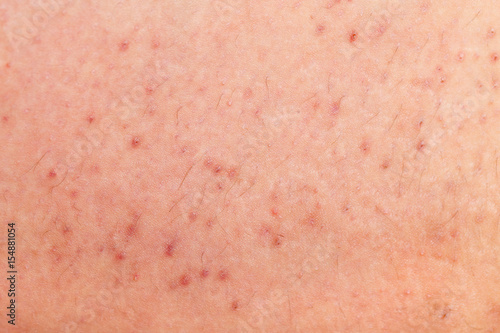 Folliculitis on human skin