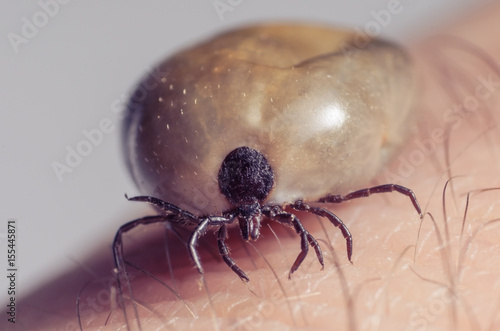 Tick filled with blood sitting on human skin