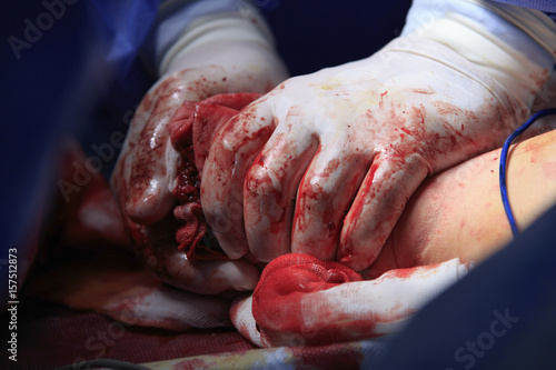 Surgeon hands in bloodstained gloves presses the stump after amputation to stop bleeding close up