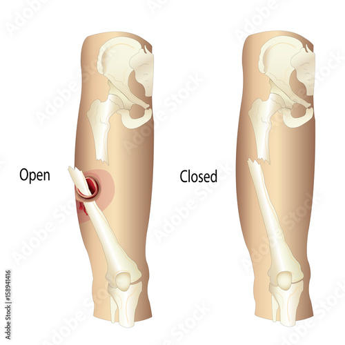 Femur Fractures, Open and Femur Fractures, Closed Vector illustration