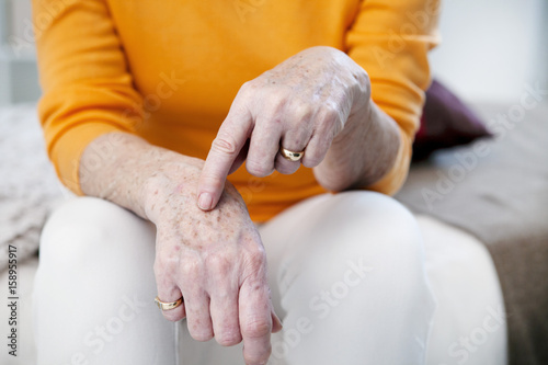 Age spots on senior woman hands