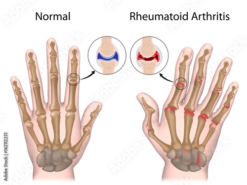 Rheumatoid arthritis of hand