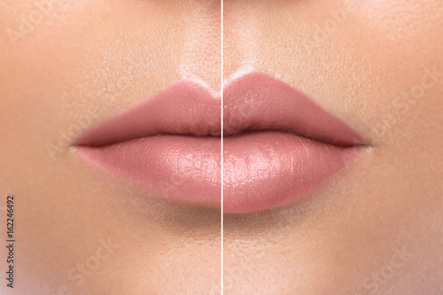 Comparison of female lips after augmentation