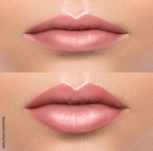 Comparison of female lips after augmentation