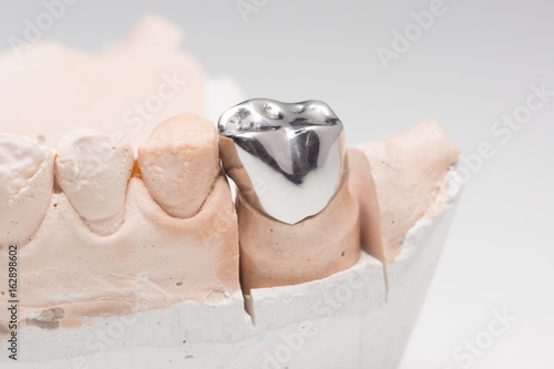 Artificial tooth crown