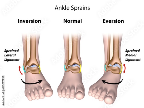 Types of ankle sprains