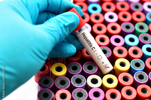 Blood sample positive with hepatitis C virus