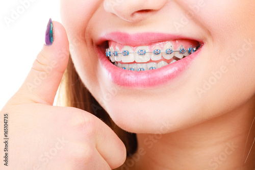 Woman showing her teeth with braces