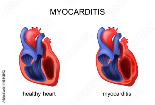 heart healthy and diseased myocarditis
