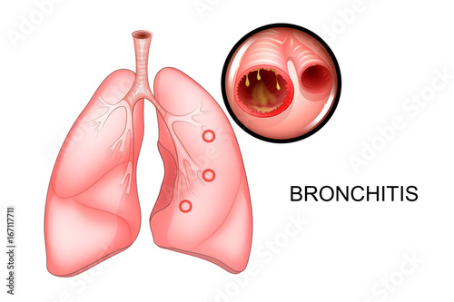 the lungs, affected with bronchitis