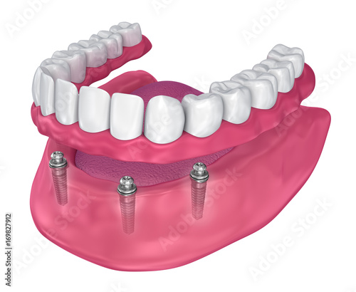 Overdenture to be seated on implants - ball attachments. 3D illustration