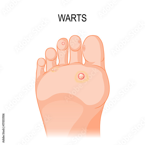 Foot wart