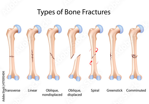 Types of bone fractures