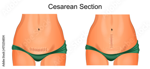 sutures after cesarean section