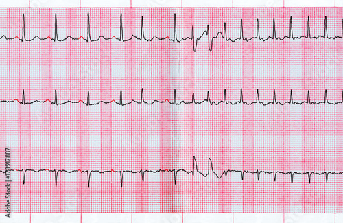 ECG with supraventricular extrasystole and short paroxysm of atrial fibrillation