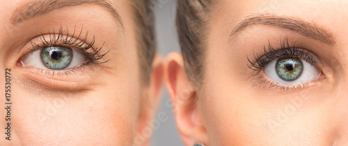 Woman eye bags before and after cosmetic treatment