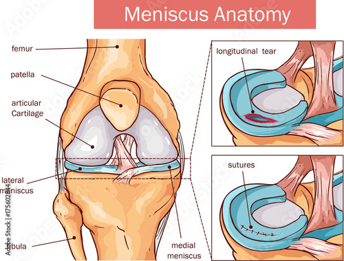 vector illustration of a Meniscus tear and surgery