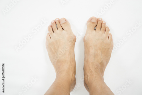 bunion in foot problem