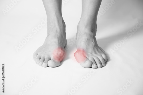 Hallux valgus, bunion in foot on white background