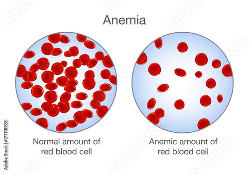 The difference of Anemia amount of red blood cell and normal. Illustration about medical.