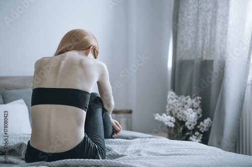 Woman with anorexia on bed