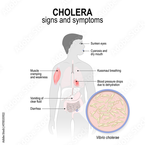  cholera. Signs and symptoms.