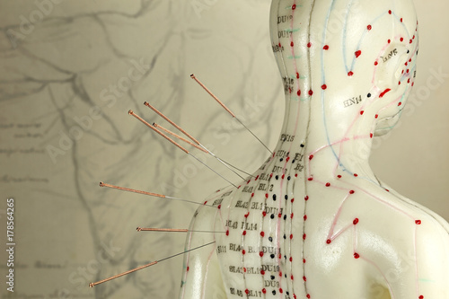 female acupuncture model with needles in the shoulder