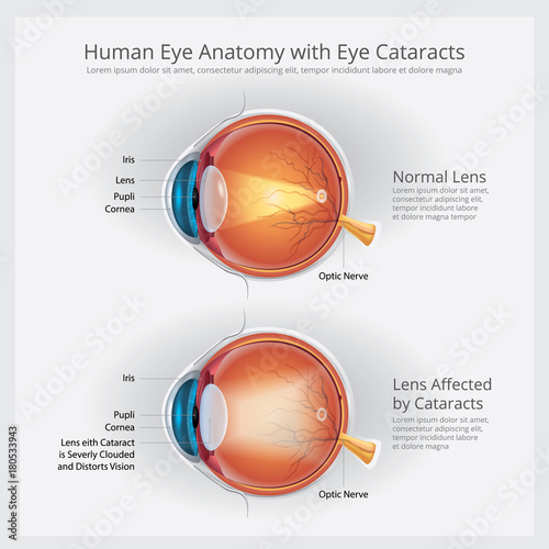 Cataracts Vision Disorder and Normal Eye Vision Anatomy Vector illustration
