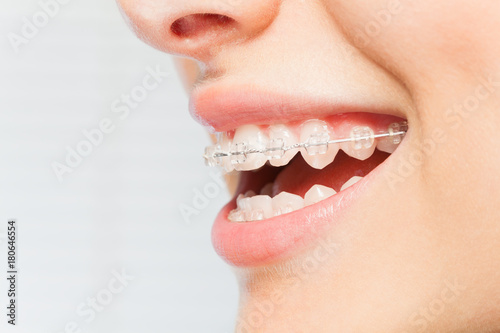 Woman's smile with clear dental braces on teeth