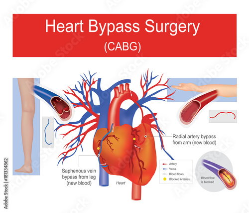 Heart bypass surgery.